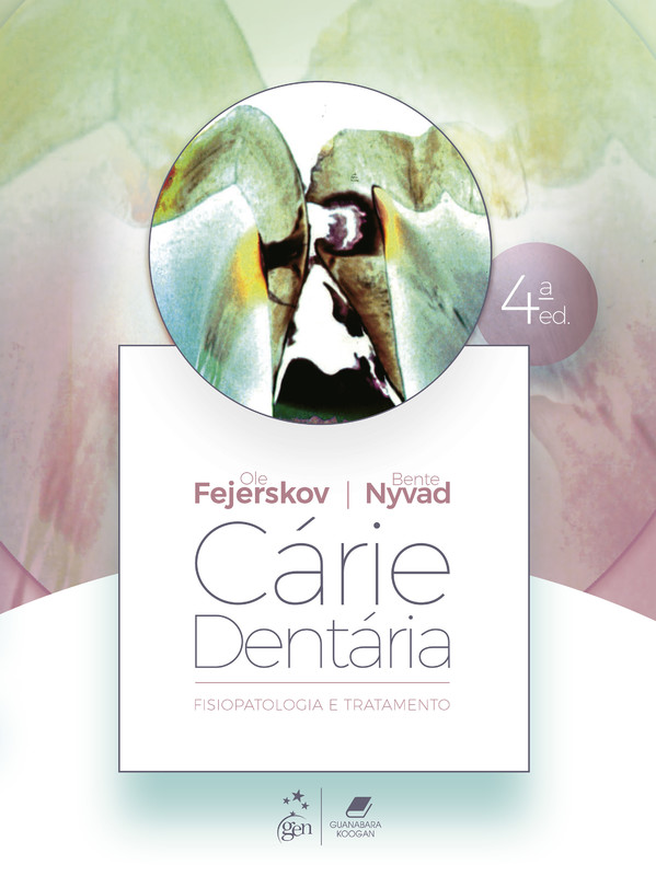 Cárie Dentária: Fisiopatologia e Tratamento