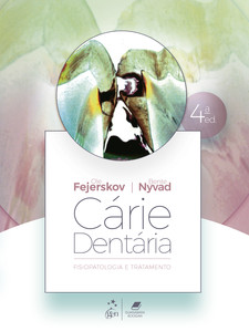 Cárie Dentária: Fisiopatologia e Tratamento
